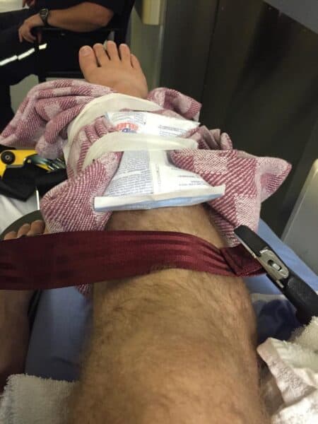 broken leg photo - from story in bonus episode 1.1 of Post-Fame Plus